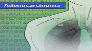 Lung Adenocarcinoma